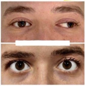 before-after photo strabismus-surgery