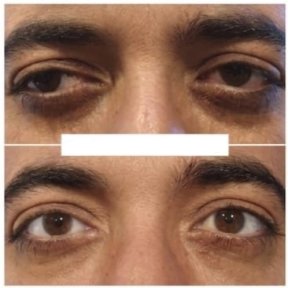 before-after photo strabismus-surgery