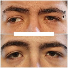 before-after photo strabismus-surgery