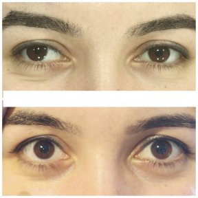 before-after photo strabismus-surgery