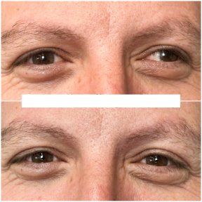 before-after photo strabismus-surgery
