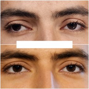 before-after photo strabismus-surgery