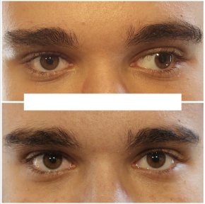 before-after photo strabismus-surgery