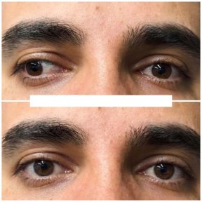 before-after photo strabismus-surgery