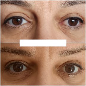 before-after photo strabismus-surgery