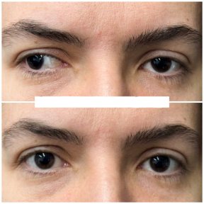 before-after photo strabismus-surgery