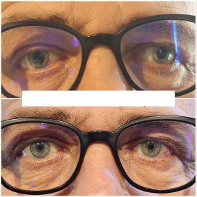 before-after photo strabismus-surgery