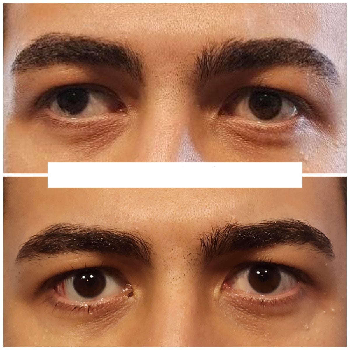 Resultado antes y después de cirugía de estrabismo en DrCagatay Eye Clinic, alineación ocular mejorada