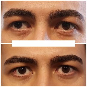before-after photo strabismus-surgery