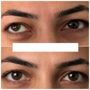 before-after photo strabismus-surgery
