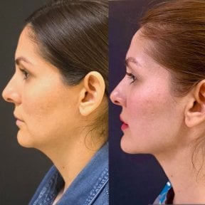 before-after photo blepharoplasty-eyelid