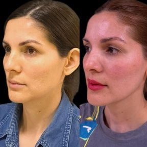 before-after photo blepharoplasty-eyelid