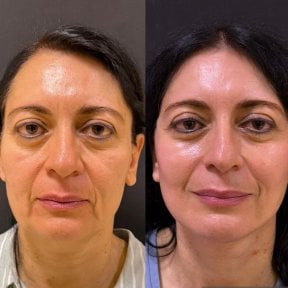 before-after photo blepharoplasty-eyelid