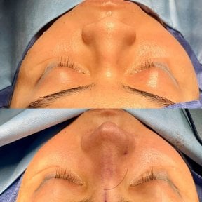 before-after photo rhinoplasty-nose-job