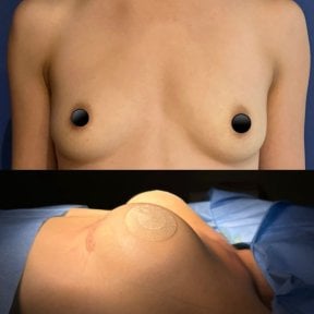 before-after photo breast-augmentation