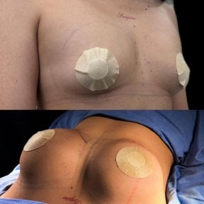 before-after photo breast-augmentation