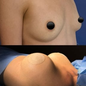 before-after photo breast-augmentation