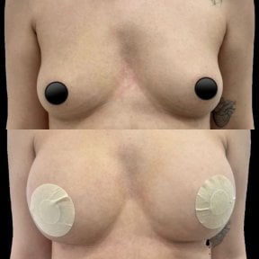 before-after photo breast-augmentation