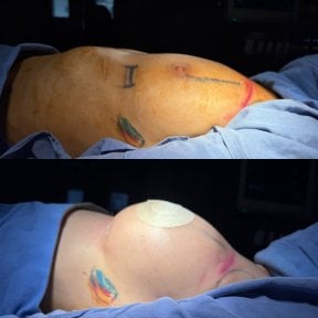 before-after photo breast-augmentation