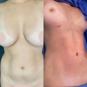 before-after photo liposuction