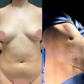 before-after photo liposuction
