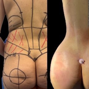 before-after photo liposuction