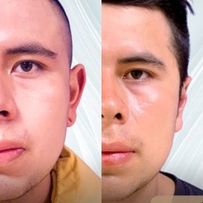 before-after photo otoplasty-ear-surgery