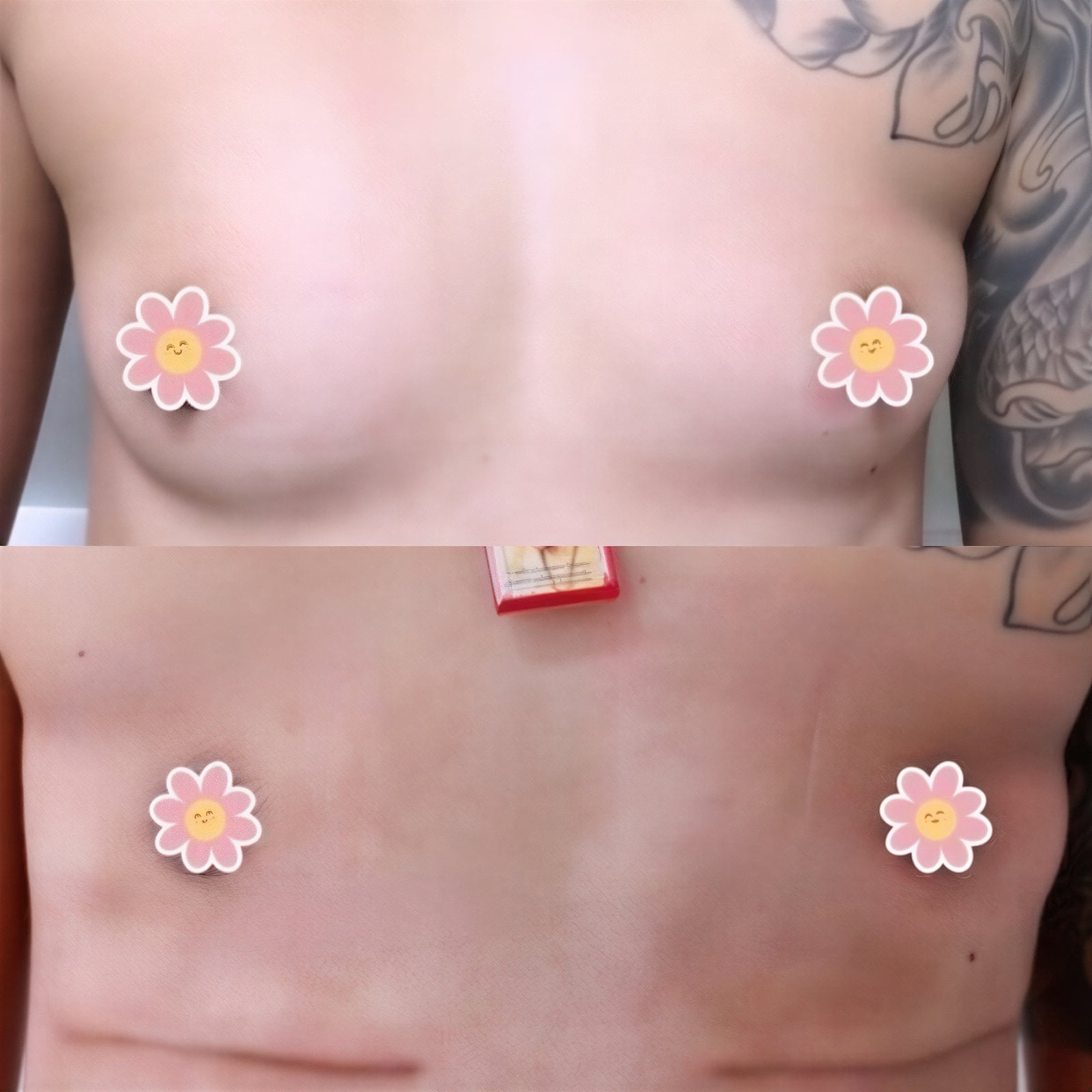 Resultados antes y después de top surgery en Somchai Clinic, masculinización de tórax