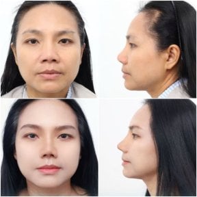 before-after photo rinoplastika-plastika-nosa