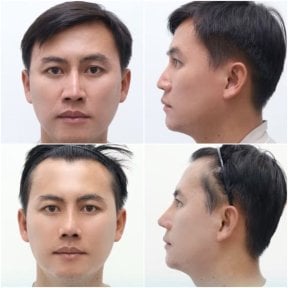 before-after photo rinoplastika-plastika-nosa