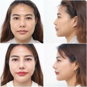 before-after photo rinoplastika-plastika-nosa