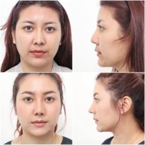 before-after photo rinoplastika-plastika-nosa