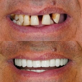 Before and after All-on-4 dental implants result at Shtern Dental Clinic, full smile restoration