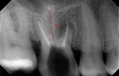 before-after photo dental-implant