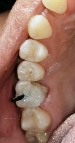 before-after photo dental-implant