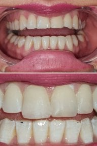 before-after photo dental-implant