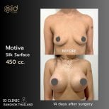 Résultats avant/après révision d’implants mammaires Motiva 450cc à ID Clinic Bangkok