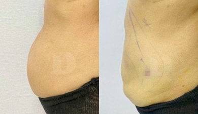 Before and after liposuction results – visible abdominal contour improvement