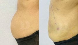 Before and after liposuction results – visible abdominal contour improvement