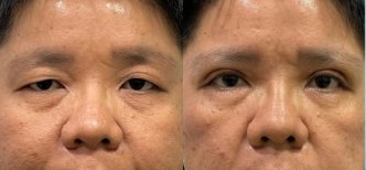 Before and after blepharoplasty results, eyelid correction with rejuvenated eye appearance