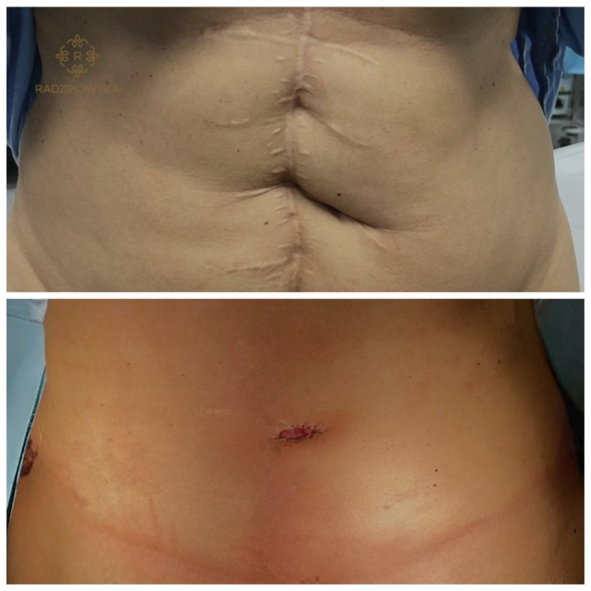Resultados de abdominoplastia y liposucción antes y después en Radzikowska Clinic, abdomen plano