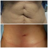 Resultados de abdominoplastia y liposucción antes y después en Radzikowska Clinic, abdomen plano