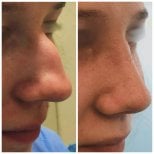 Resultados de rinoplastia antes y después en Radzikowska Clinic, mejora de la nariz
