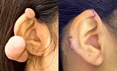 Before and after otoplasty results – ear keloid removal and ear shape improvement