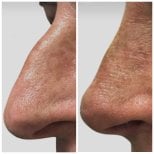 Resultado de rinoplastia antes y después en Radzikowska Clinic, mejora de forma nasal