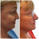 Resultados antes y después de deep plane facelift en Radzikowska Clinic, rejuvenecimiento facial