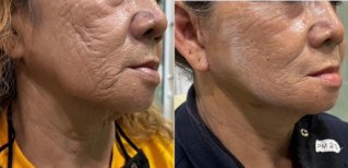 Facelift before and after results – reduced wrinkles and firmer skin on lower face