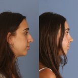 نتائج عملية تجميل الأنف قبل وبعد، إعادة تشكيل الأنف لتحسين المظهر والتناغم
