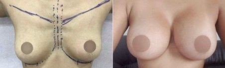 Before and after breast augmentation results – enhanced breast shape and volume
