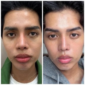 Before and after rejuvenation with own stem cells, facial skin improvement results